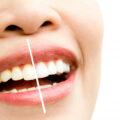 Teeth Whitening and Bleaching Solutions