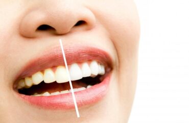 Teeth Whitening and Bleaching Solutions